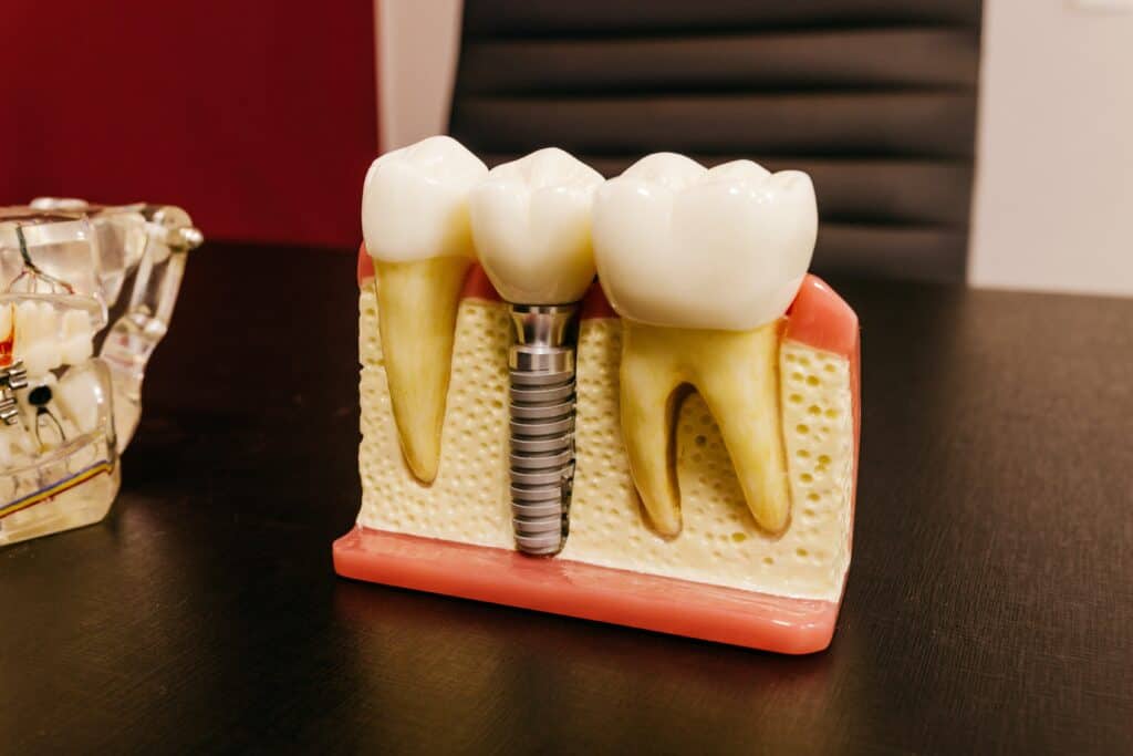 Zahnimplantate_Implantologie Balingen